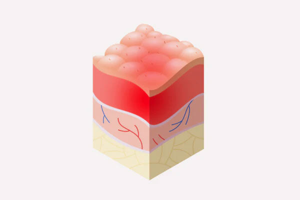 Image of an illustration of skin irritation on the skin's layers